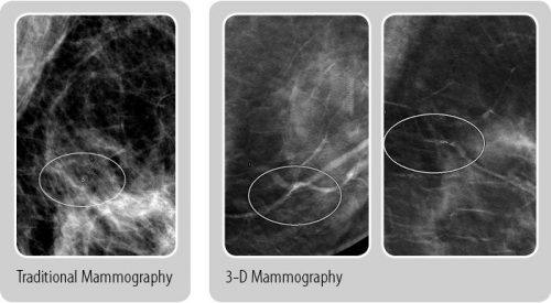 3d mammo