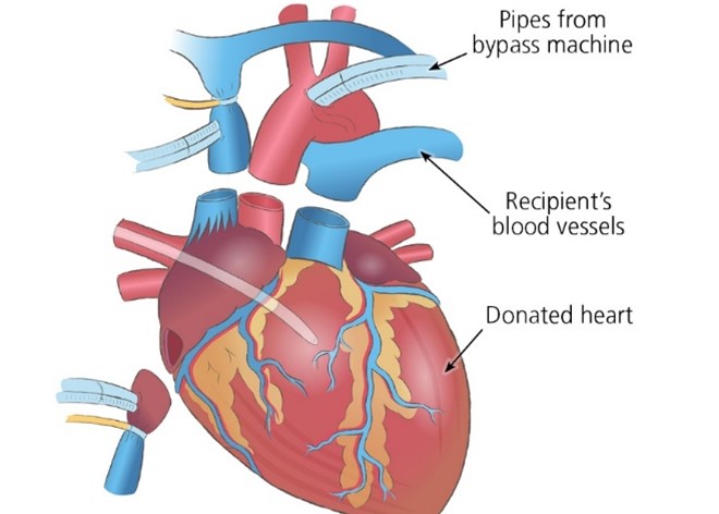 Heart transplant graphic