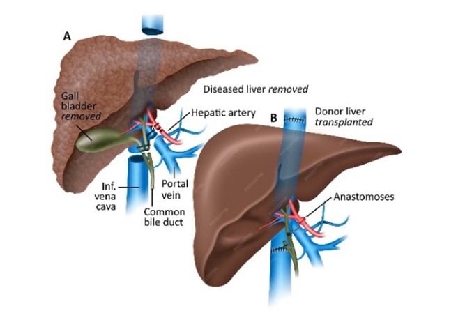 Liver transplant