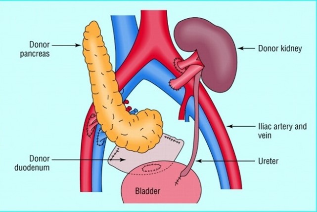 Pancreas transplant diagram