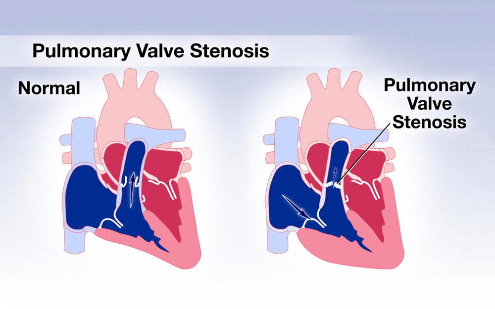 ​​​​pulmonary valve
