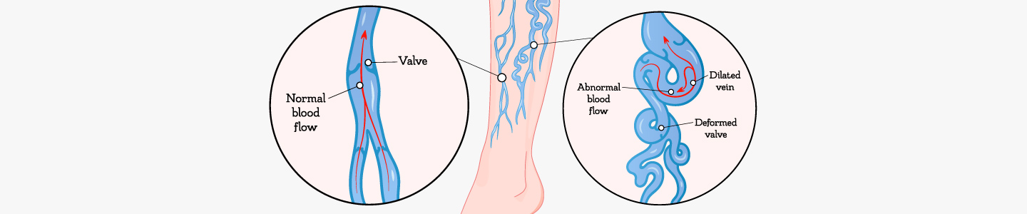 varicose veins