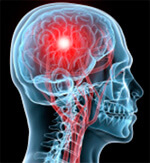 brain scan of a stroke