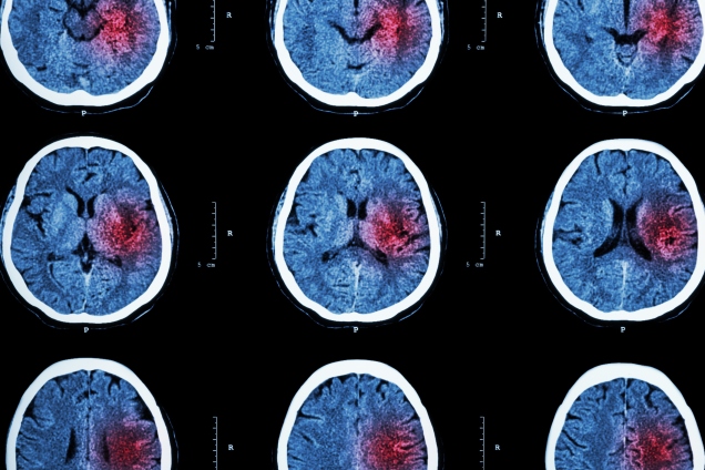 brain scans - stroke