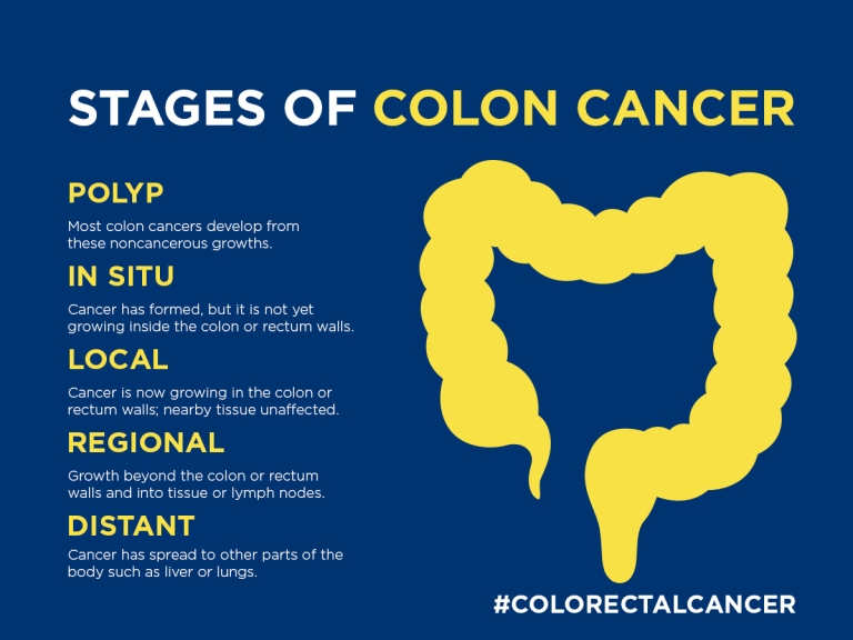 Stages of Colon Cancer flyer