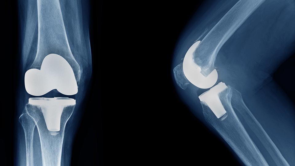 Knee implant xray
