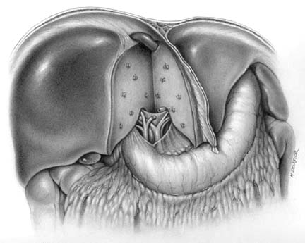 Liver Resection