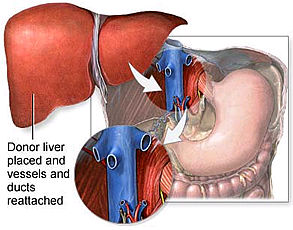 Liver Transplant