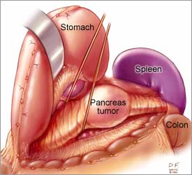 Pancreas tumor