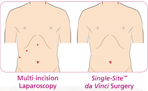 Body image for Multi Incision Laparoscopy and Single Site da Vinci Surgery