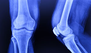 Knee xray